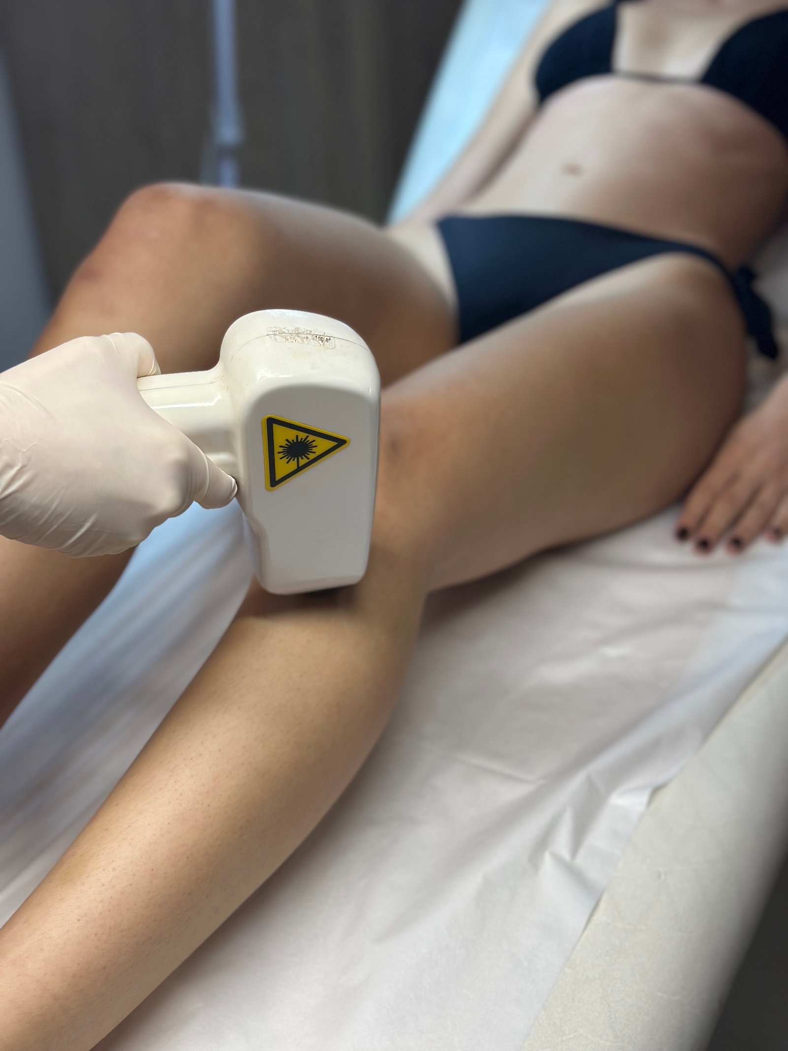 Laser Αποτρίχωση