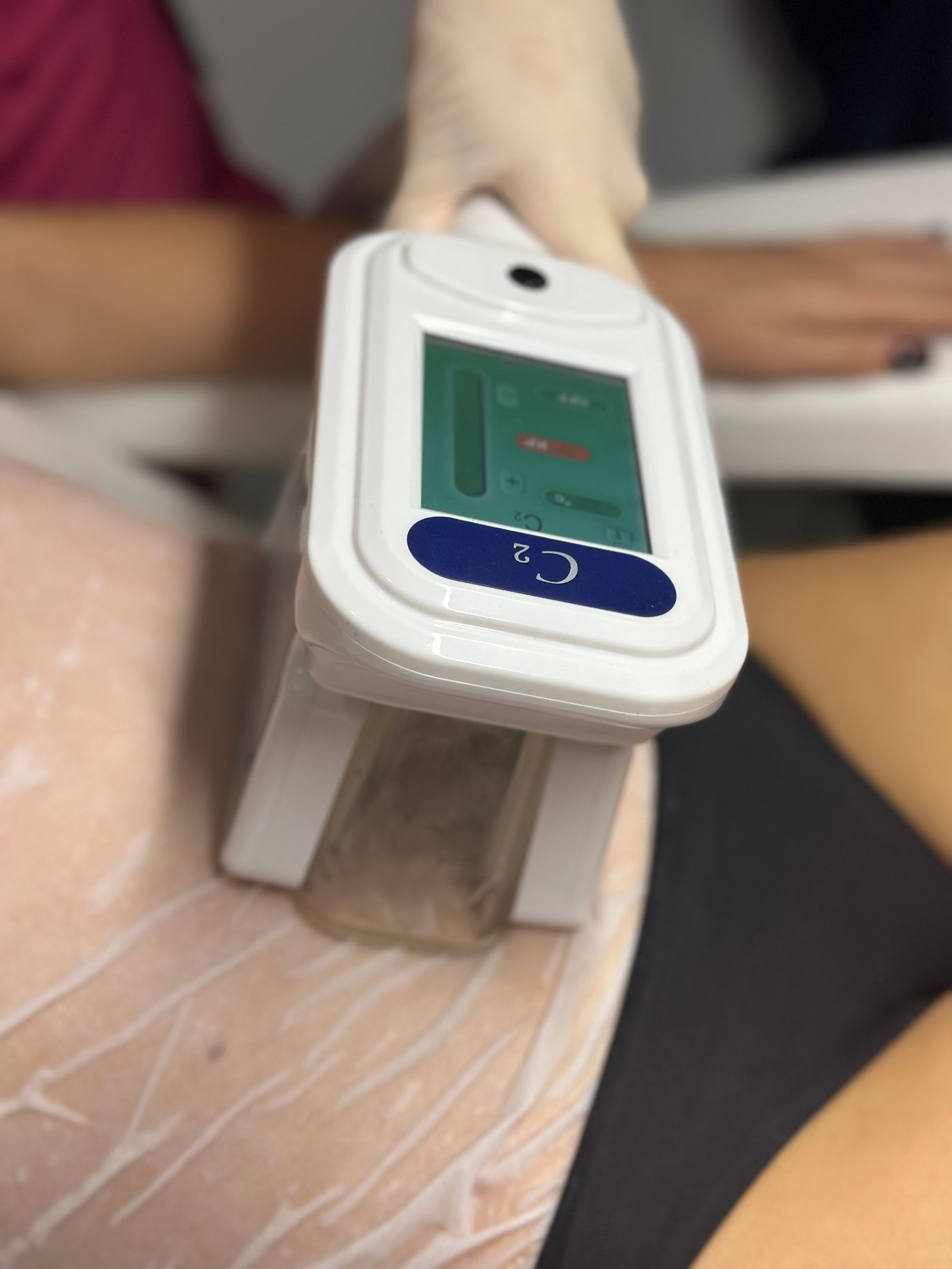 Κρυολιπόλυση